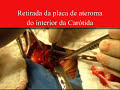 Cirurgia de artéria Carótida interna(Endarterectomia). www.varizesvaladares.com Cirurgia de artéria Carótida interna(Endarterectomia). www.varizesvaladares.com