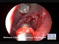 surgical case performed by dr. richard harvey, medical university of south carolina. visit www.xorancommunity.com for more details.