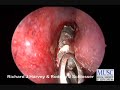 surgical case performed by dr. richard harvey, medical university of south carolina. visit www.xorancommunity.com for more details.