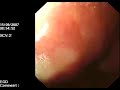 Endoscopy Exam Endoscopy Exam
