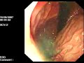 Endoscopy Exam Endoscopy Exam