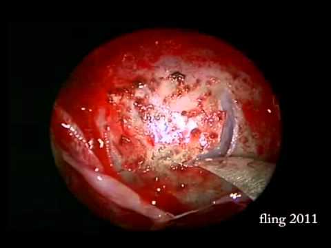 Cystic Pituitary Macroadenoma Endoscopic Resection