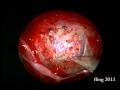 Cystic Pituitary Macroadenoma Endoscopic Resection Cystic Pituitary Macroadenoma Endoscopic Resection