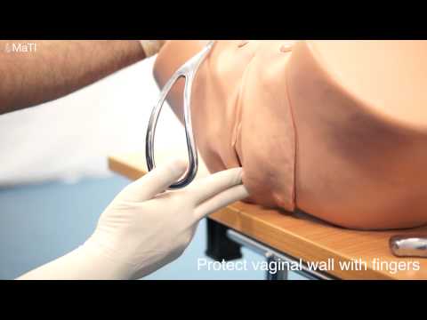 delivery - This is a demonstration on how to apply long traction forceps at delivery.