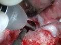 Cirurgia Paraendodontica (ABO) Parte 2