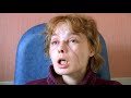 BBC-The Worlds First Face Transplant