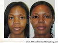 African American Rhinoplasty- AfricanAmericanRhinoplasty.com