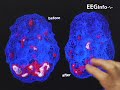 SPECT scran pre post Neurofeedback on PTSD SPECT scran pre post Neurofeedback on PTSD