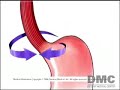Relief from Acid Reflux