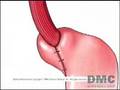Relief from Acid Reflux