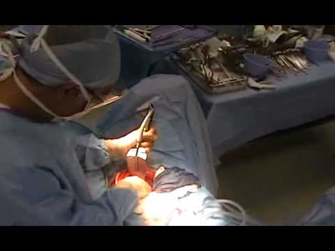 Colon Surgery - To learn more go to NiTi™ Surgical Solutions website: http://www.nitisurgical.com Colorectal Surgery live video - lower anterior resection (LAR) demonstratin...
