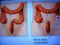 Limpieza Intestinal