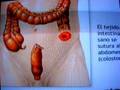 Limpieza Intestinal