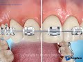 Flossing Braces with Superfloss (Good Hygiene)