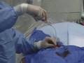 Carotid Stent Procedure Live Panel Discussion 