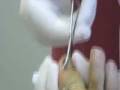 toe nail removal