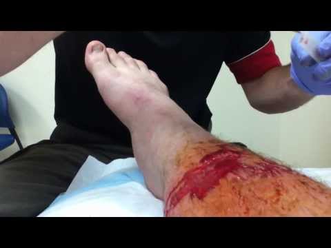 how to drain staph infection