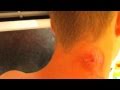 Bennetts boil burst