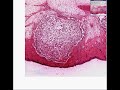Histopathology Skin -- Furuncle (abscess) Histopathology Skin -- Furuncle (abscess)