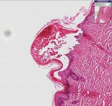 Histopathology Skin--Varicella ...