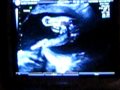 20 Week Ultrasound with the Turnip