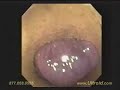 Hemorrhoid cure,hemorrhoid doctors Hemorrhoid cure,hemorrhoid doctors