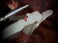 Realize Adjustable Gastric Band placement