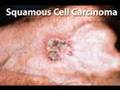 Understanding Squamous Cell Carcinoma (Health Short)