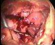 Laparoscopic treatment of acute pevic inflamation disease