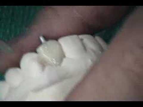 Transitional SIngle crown on implant