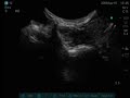 Ultrasound-Guided Stellate Ganglion Block Ultrasound-Guided Stellate Ganglion Block