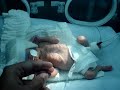 Beb� prematuro