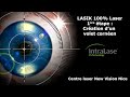 LASIK 100% Laser