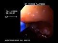 Ectasia vascular de antro