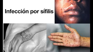 14 - Infección por sífilis - Todo lo que debes saber - Síntomas, Diagnóstico y Tratamiento