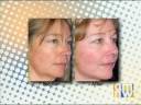 Pearl Fractional & Pearl Lasers on News in Vancouver, WA