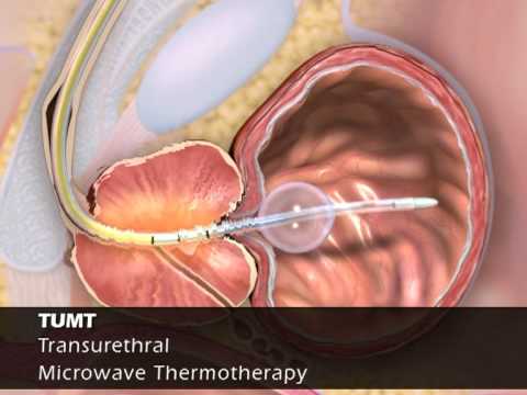 how to treat bph