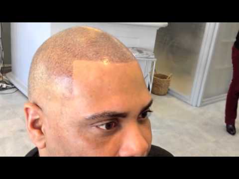 how to cover up hair transplant