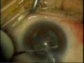 Phaco, torsional mode, Horizontal chopping Brown case