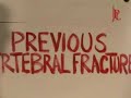 Numbers Needed to Treat  Menopause Calcium