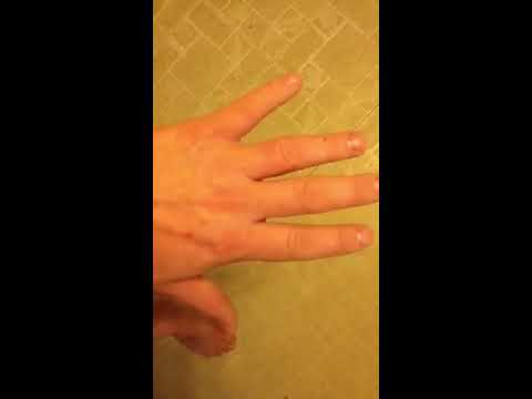 how to relieve poison ivy swelling