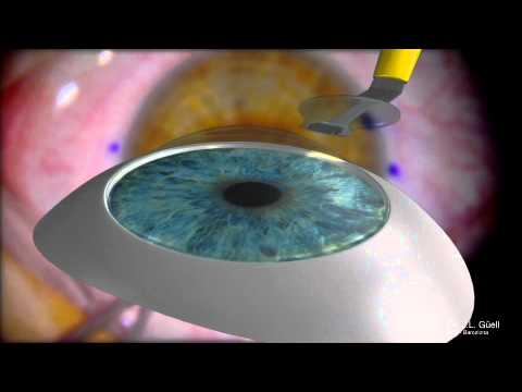 Artiflex Toric step by step 