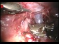 Pulmonary Artery Repair