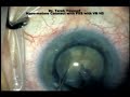 Hypermature Cataract with PXS VB H5