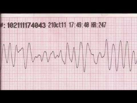 how to treat qt prolongation
