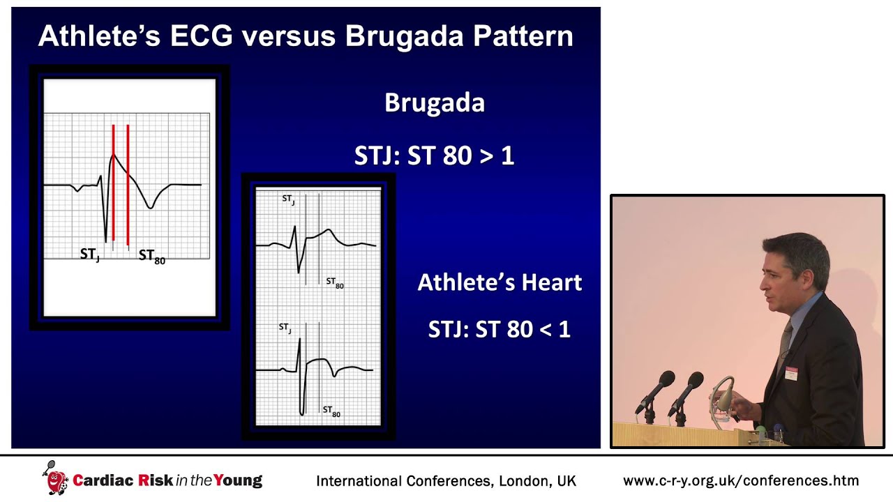 Challenges of diagnosing ion  channelopathies in athletic individuals