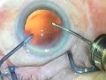 Capsulorhexis Complications: Overview Phaco 3.2 Complication Capsulorhexis Complications: Overview Phaco 3.2 Complication