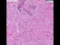 Histopathology Breast--Lobular carcinoma