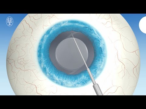 Refractory Lens Exchange (RLE)