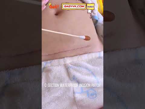 C-Section Waterproof Incision Patch: Protect Your Healing Scar in Every Shower #MomTips #CSection
